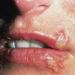 À quoi ressemble une éruption due à l’herpès labial ?