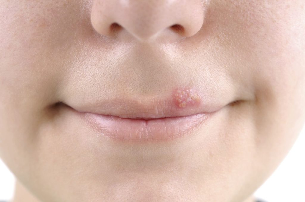 cold sore mouth