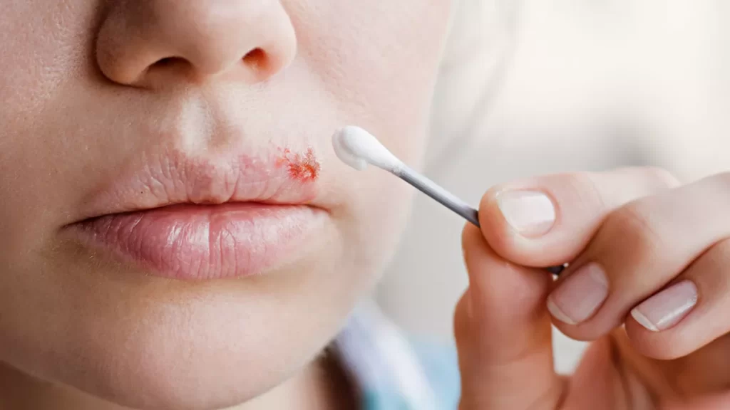 comment se debarrasser rapidement dun bouton de fievre