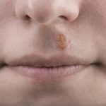Comment traiter un bouton de fièvre dans le nez ?