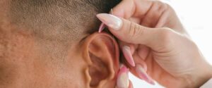 Acupuncture de l oreille