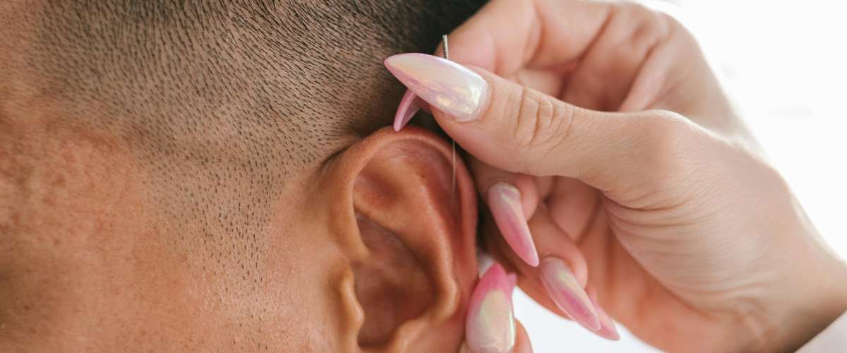 Acupuncture de l oreille